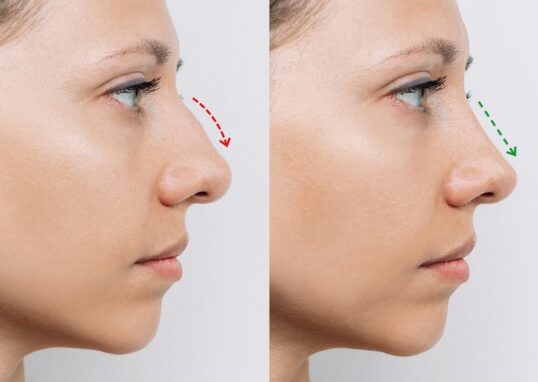 Två bilder före och efter näsplastik